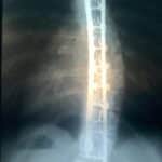 Scoliosis