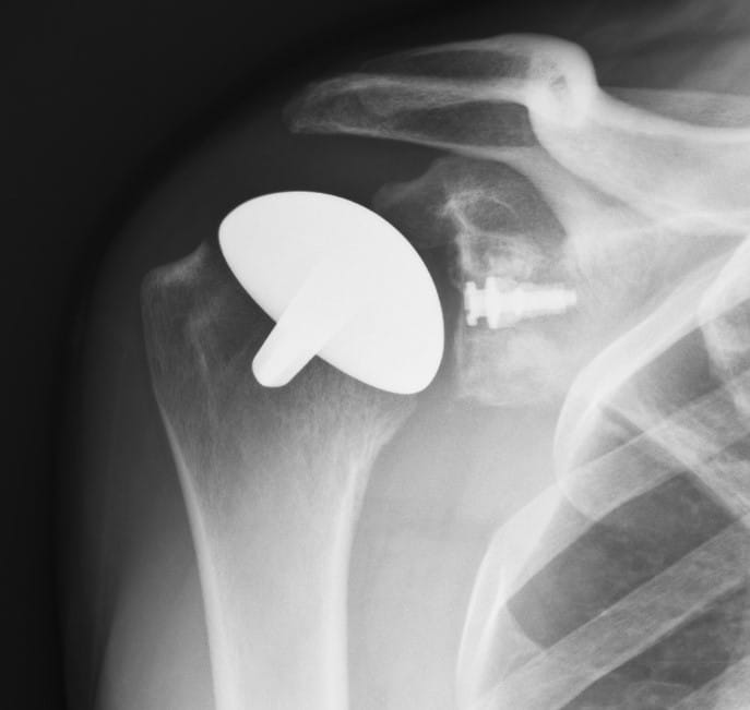 Fig. 2 This AP Shoulder Radiograph show a shoulder resurfacing with a polyethylene glenoid.