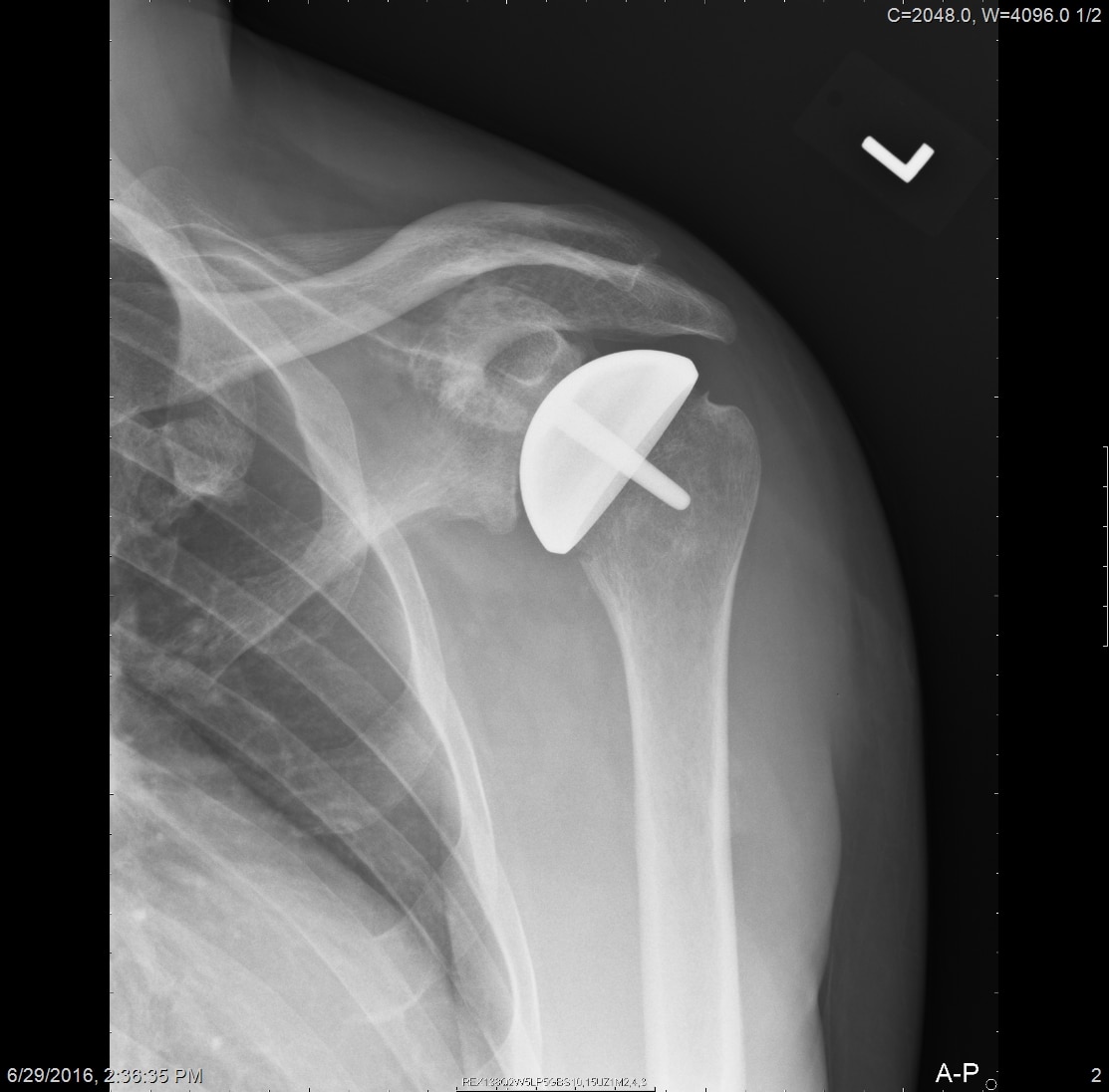 Fig. 3 This AP Shoulder Radiograph shows a shoulder resurfacing hemiathroplasty.