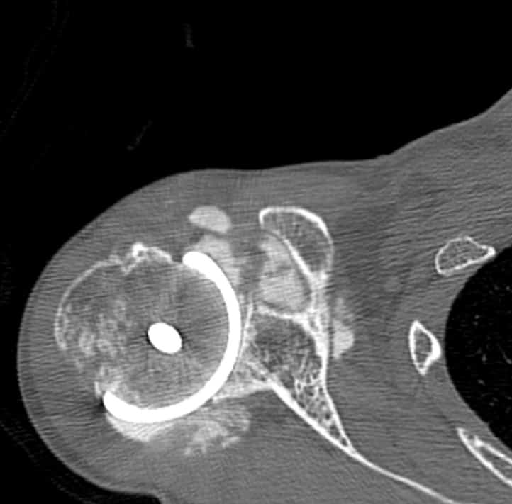 Fig. 4 This CT arthrogram shows a shoulder resurfacing hemiarthroplasty with 4 mm of glenoid cartilage wear.