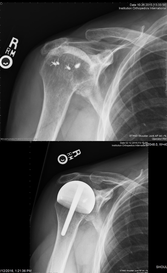 Fig. 5 The top AP shoulder radiograph shows a multiply operated right shoulder with rotator cuff arthropathy. The bottom AP shoulder radiograph shows a shoulder resurfacing performed with a femoral component covering the tuberosity’s and articulating with the acromion and glenoid.