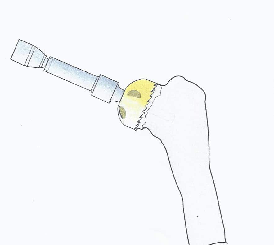 Fig. 6 This drawing shows the shaper instrument for preparation of the humeral head prior to resurfacing.